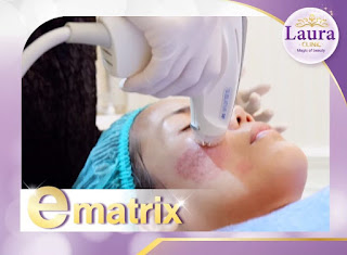 ลอร่าคลินิก บริการทำ subcision (ซับซีชั่น) คือการใช้ปลายเข็ม เข้าไปตัดผังผืดบริเวณใต้ฐานของหลุมสิว ด้วยเครื่อง E-matrix