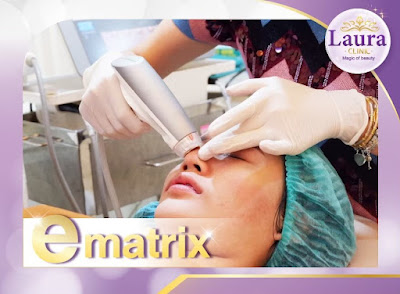 ลอร่าคลินิก บริการทำ subcision (ซับซีชั่น) คือการใช้ปลายเข็ม เข้าไปตัดผังผืดบริเวณใต้ฐานของหลุมสิว ด้วยเครื่อง E-matrix